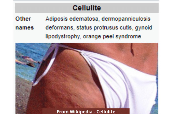 rebounding-and-cellulite-fact-and-fiction